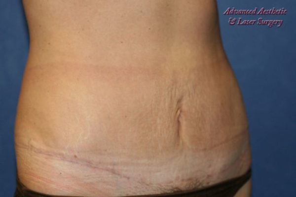 Abdominoplasty