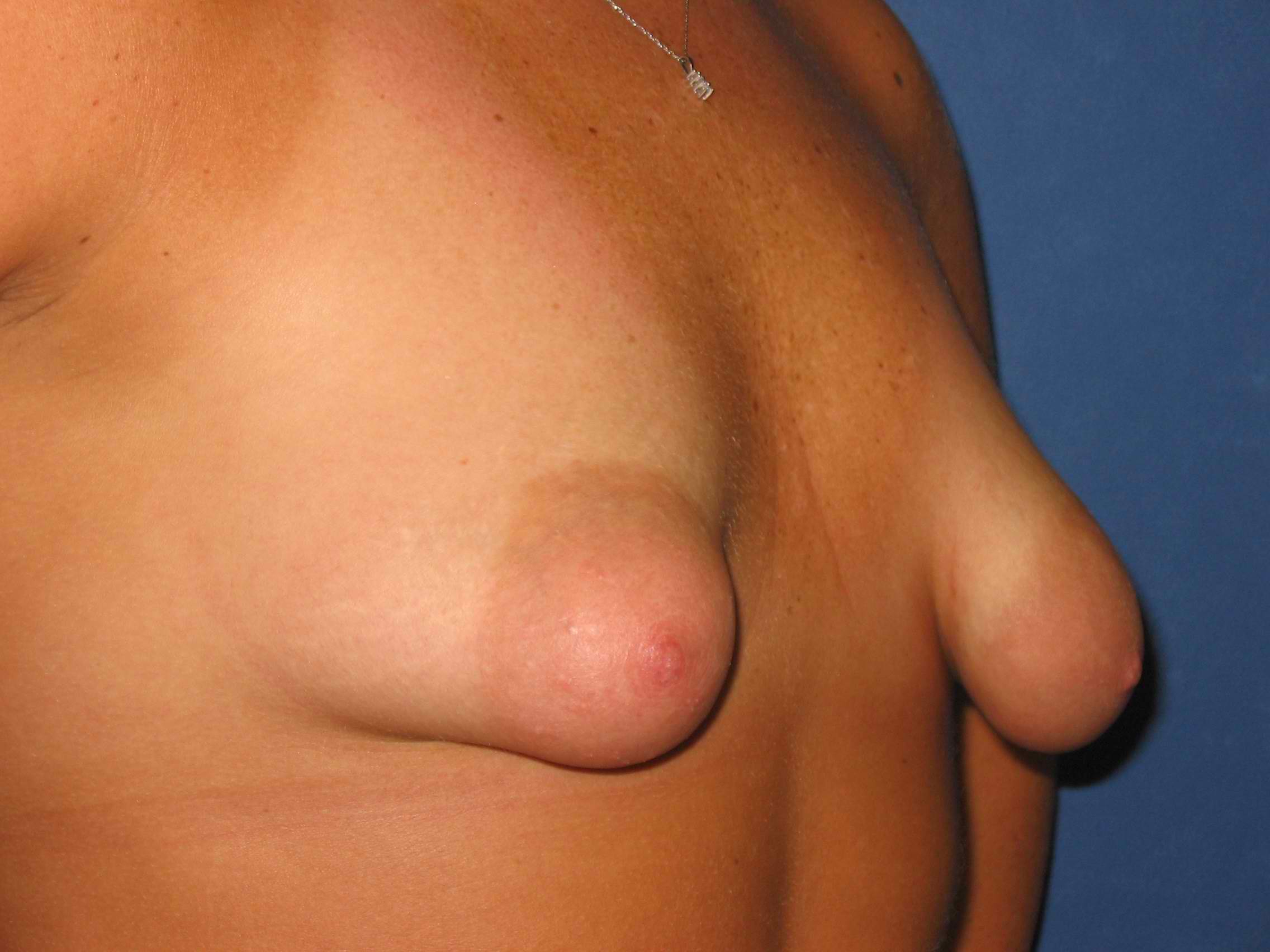 грудь тубулярная у женщин фото 110