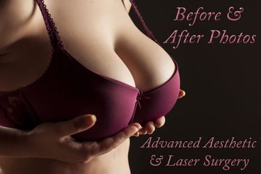 Bands' & 'Straps' after Breast Augmentation Columbus OH