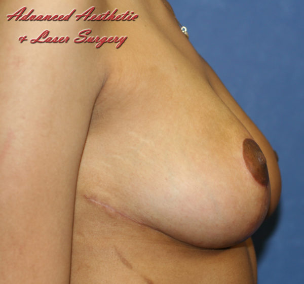 Breast Reduction