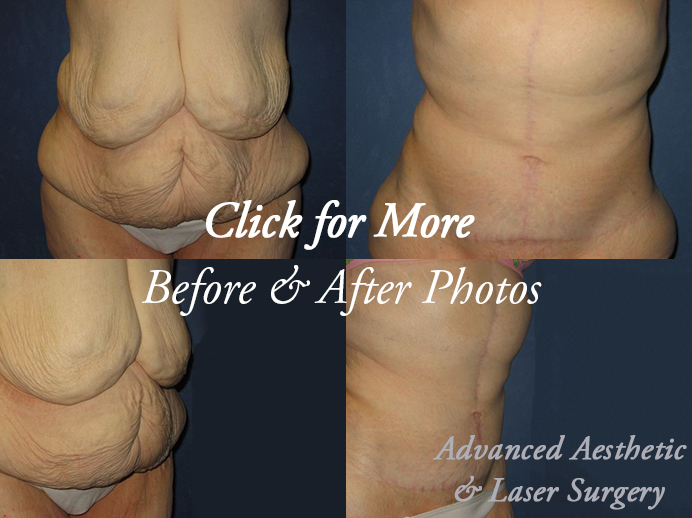 Body Contouring After Massive Weight Loss Columbus OH