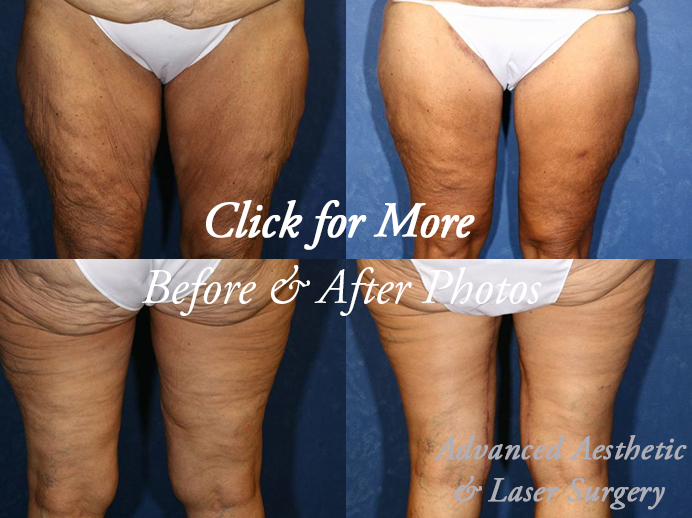 Thigh Lift Cosmetic Surgery in Morgantown, WV and surrounding