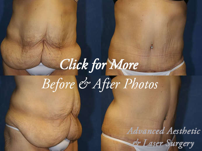 RECOVERING FROM A TUMMY TUCK