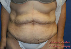 Tummy Tuck Before & After Photos Patient 297, Columbus, OH