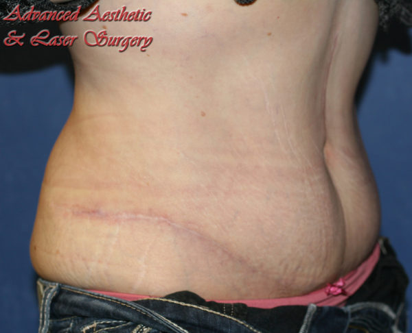 Abdominoplasty